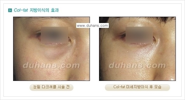 [두한성형외과 경쟁력 미세지방이식] - [지방이식 특허 Col-fat 미세지방이식 성공사례 안내] 관련 이미지 3