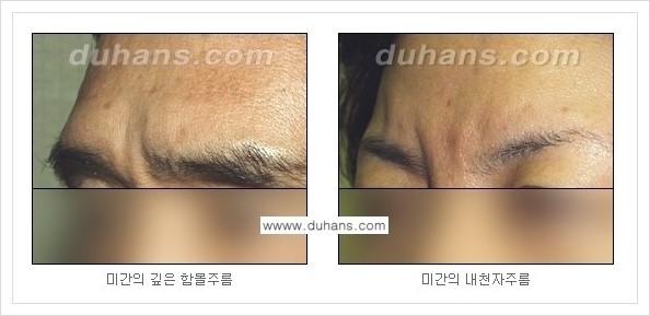 ​[두한성형외과 경쟁력 주름성형] - [주름교정을 위한 미세지방이식 안내 1.] 관련 이미지 3