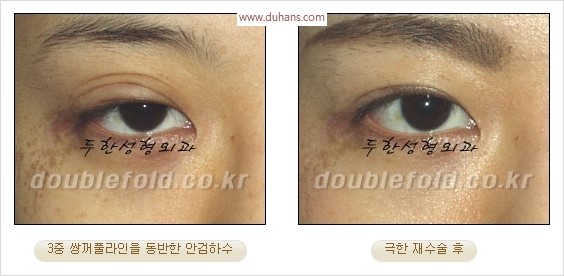 [두한성형외과 경쟁력 눈성형] - [극한 재수술, 함몰된 눈꺼풀 라인교정, 안검하수(졸리운 눈매)] 관련 이미지 20