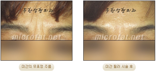[Duhan Plastic Surgery Wrinkle Improvement] - [Wrinkle Filler Procedure] image 11