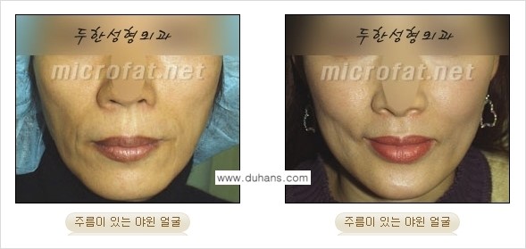 [두한성형외과 경쟁력 미세지방이식] - [타 병원에서 볼살 지방이식 이후 부작용 교정 방법 안내] 관련 이미지 1