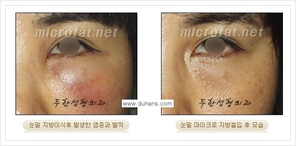 [두한성형외과 겨울엔 지방흡입을] - [볼살, 눈밑, 턱선의 초음파 미세지방흡입 1.] 관련 이미지 7