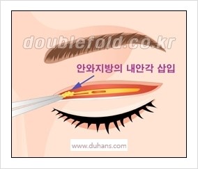 [두한성형외과 경쟁력 눈성형] - [쌍꺼풀 재수술 실패의 원인과 문제점] 관련 이미지 6