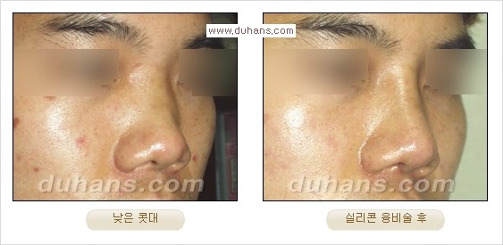 [두한성형외과 경쟁력 코성형] - [코성형을 위한 알로덤(슈어덤) 수술, 실리콘 수술 안내] 관련 이미지 34