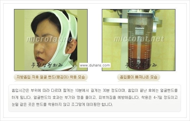 [두한성형외과 경쟁력 미세지방이식] - [타병원에서의 미세지방이식 부작용 교정 방법 안내] 관련 이미지 6