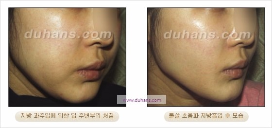 [두한성형외과 경쟁력 지방흡입] - [볼살, 턱선의 간편 지방흡입] 관련 이미지 23