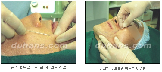 [두한성형외과 얼굴자가지방이식] - [지방이식 과정] 관련 이미지 5