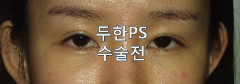 [두한성형외과 쌍꺼풀재수술]-[#라인키우기 #비대칭 #낮은라인 #울퉁불퉁 #짝눈] 관련 이미지 1