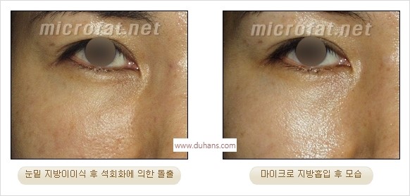 [두한성형외과 경쟁력 미세지방이식] - [지방이식 부작용 교정 모습 안내] 관련 이미지 30