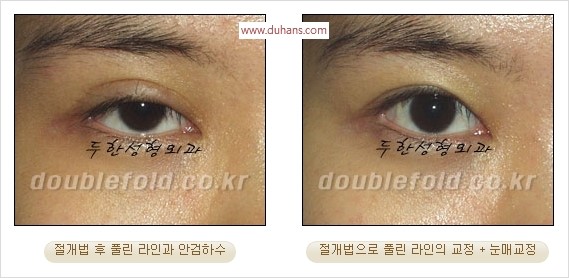 [두한성형외과 경쟁력 눈성형] - [쌍꺼풀 재수술에 대한 최선의 대안 제시] 관련 이미지 82