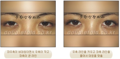 [Duhan Plastic Surgery Eye Surgery] - [Asymmetric Line, Eyelash Eversion, Deep Fixation] image 16