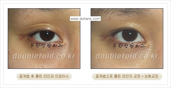 [두한성형외과 경쟁력 쌍꺼풀 재수술, 극한 눈재수술] - [풀린 쌍꺼풀 라인 교정수술 안내] 관련 이미지 6