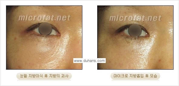 [두한성형외과 경쟁력 미세지방이식] - [미세지방이식 부작용 교정] 관련 이미지 3