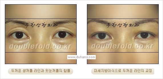 ​⁠⁠[두한성형외과 경쟁력 쌍꺼풀 재수술, 극한 눈재수술] - [지방이식으로 눈매와 쌍꺼풀 라인을 교정] 관련 이미지 10
