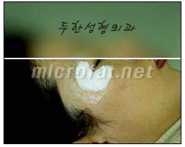 [Duhan Plastic Surgery Wrinkle Improvement] - [Wrinkle Filler Procedure] image 6