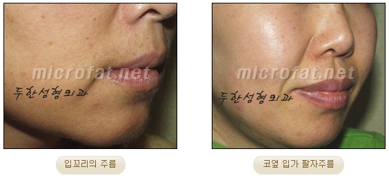 Wrinkle Improvement, Duhan Plastic Surgery - Mouth Lines, Nasolabial Folds image 3