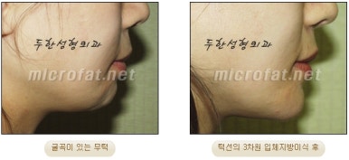 [두한성형외과 무턱교정 ] - [무턱 지방이식] 관련 이미지 26