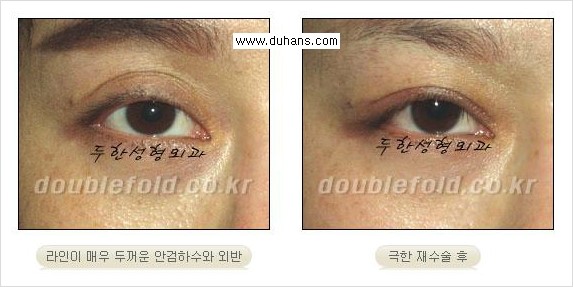 [두한성형외과 경쟁력 쌍꺼풀 재수술, 극한 재수술] - [재수술에서 극복해야 할 극한의 상황과 문제들 안내] 관련 이미지 17