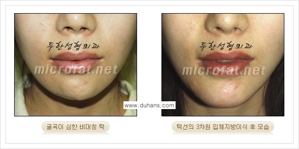 [두한성형외과 경쟁력 안면윤곽 교정] - [미세지방이식으로 무턱, 작은턱, 오목턱, 턱선의 비대칭 교정 안내] 관련 이미지 10