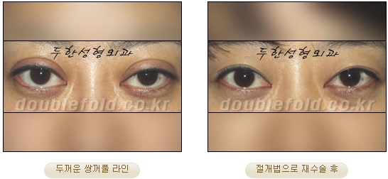 [Duhan Plastic Surgery Double Eyelid Revision Surgery] - [Ptosis Correction Surgery] image 44