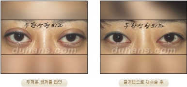 Best Place for Revision Eyelid Surgery, Duhan Plastic Surgery - Lowering Double Eyelid Line image 36