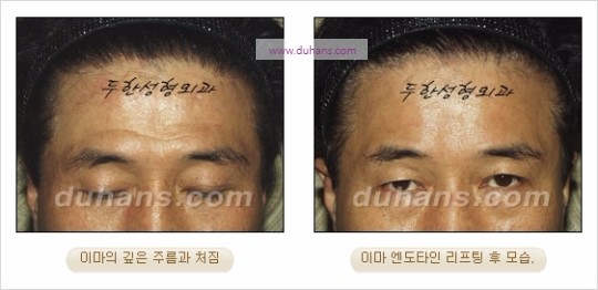 [두한성형외과 주름성형] - [주름교정술 - 강력한 리프팅 파워 엔도타인 리프팅 ] 관련 이미지 25