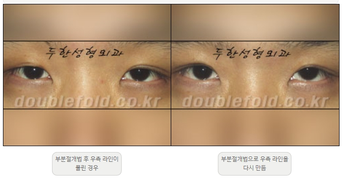 [두한성형외과 쌍커플재수술] - [비대칭 쌍커풀 라인] 관련 이미지 11