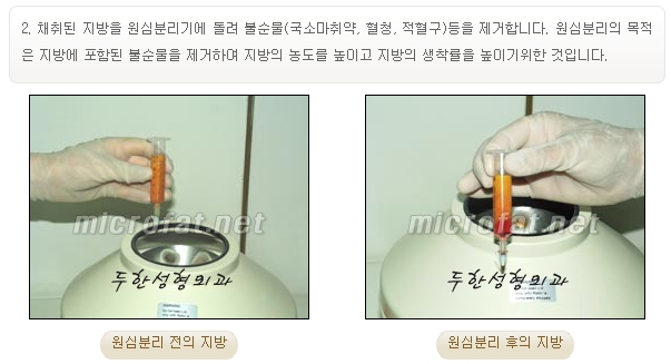 [두한성형외과 경쟁력 주름성형] - [입가와 팔자의 주름제거 지방이식 1.] 관련 이미지 2