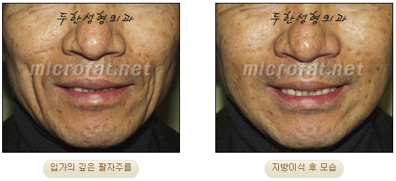 Wrinkle Improvement, Duhan Plastic Surgery - Mouth Lines, Nasolabial Folds image 20