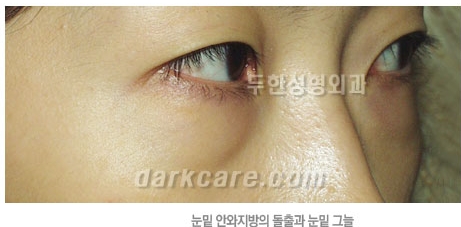 [두한성형외과 다크서클 수술방법] - [NO흉터 눈밑지방제거] 관련 이미지 3