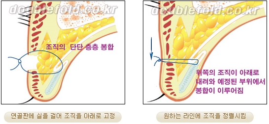 Best Place for Revision Eyelid Surgery, Duhan Plastic Surgery - Lowering Double Eyelid Line image 35