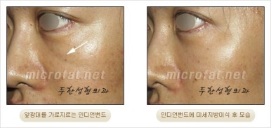 [Facial Autologous Fat Grafting, Duhan Plastic Surgery] - [Indian Wrinkle] image 15