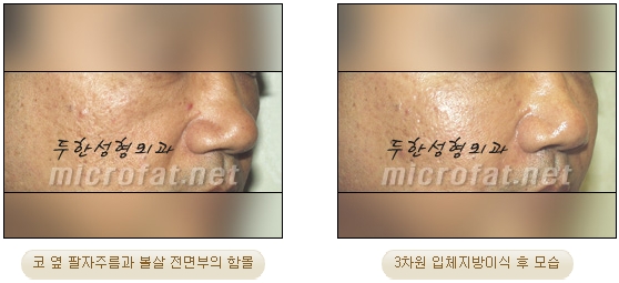 [Duhan Plastic Surgery Face Autologous Fat Grafting] - [Noble Surgery and Indian Band Fat Grafting] image 16