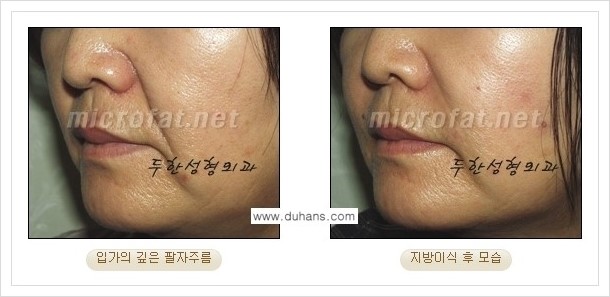 [두한성형외과 경쟁력 지방이식] - [입가주름, 팔자주름 미세지방이식의 안내] 관련 이미지 12
