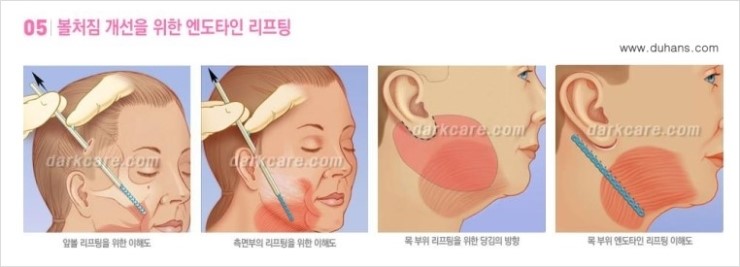 [두한성형외과 경쟁력 다크써클 치료] - [다크써클 + 엔도타인 리프팅 콤비 프로그램] 관련 이미지 7