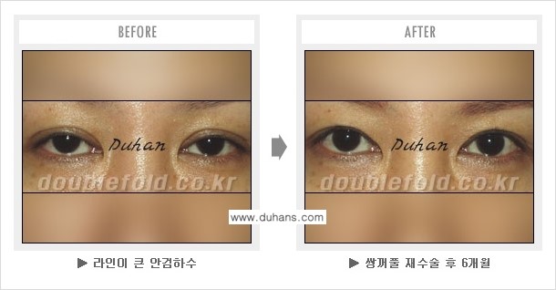 [두한성형외과 쌍꺼풀 재수술] - [쌍꺼풀 재수술에서 잘못된 수술로 인한 넓어진 흉터 처리 문제] 관련 이미지 6