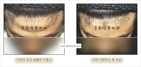 [두한성형외과 경쟁력 동안성형 리더] - ​[미간주름, 이마주름, 안검성형, 이마거상술, 눈썹거상술] 관련 이미지 34