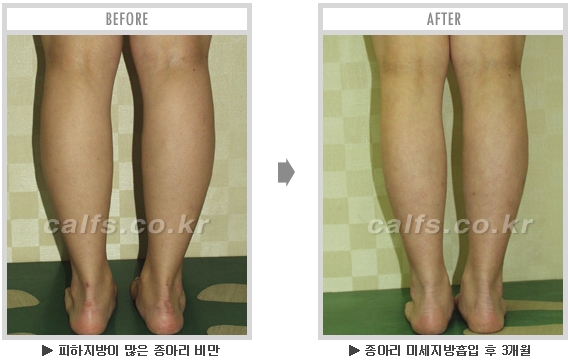 [종아리성형 두한성형외과] - [종아리수술에 대한 자주하는 질문과 답변 모음] 관련 이미지 78