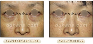 두한성형외과 눈밑성형 - 눈밑지방제거, 눈밑주름, 눈밑지방재배치 관련 이미지 64