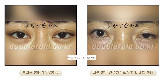 [두한성형외과 경쟁력 쌍꺼풀 재수술, 극한 눈재수술] - [안검하수(졸린 눈매)의 종류 안내] 관련 이미지 1