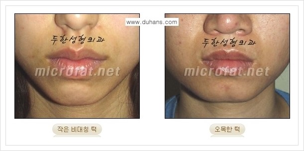 [두한성형외과의 경쟁력 미세지방이식] - [무턱교정, 턱 미세지방이식 안내 1.] 관련 이미지 1