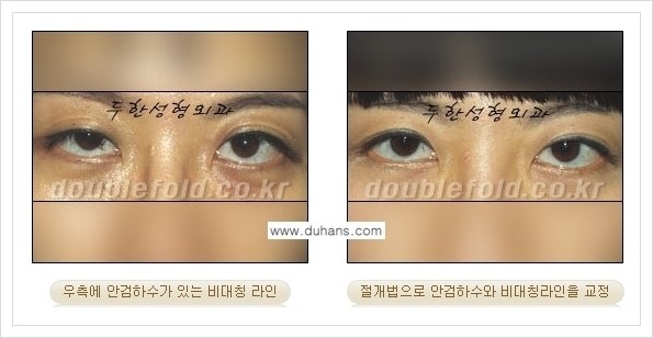 [두한성형외과 경쟁력 쌍꺼풀 재수술, 극한 재수술] - [안검하수(졸린눈매) 교정 방법 안내] 관련 이미지 6
