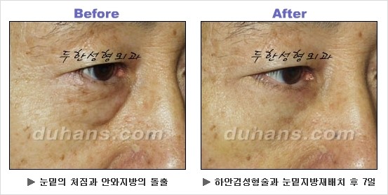 [두한성형외과 경쟁력 동안성형 리더] - ​[미간주름, 이마주름, 안검성형, 이마거상술, 눈썹거상술] 관련 이미지 115