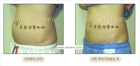 [두한성형외과 겨울엔 간편 지방흡입] - [복부, 뱃살, 아랫배, 옆구리 지방흡입 도전!] 관련 이미지 2