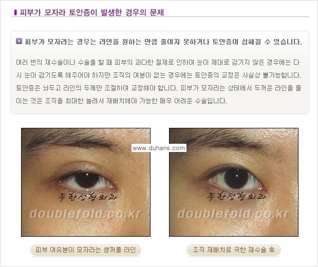 [두한성형외과 극한 재수술, 쌍꺼풀 재수술] - [쌍꺼풀 재수술에서 극복해야 할 극한의 상황과 문제] 관련 이미지 7