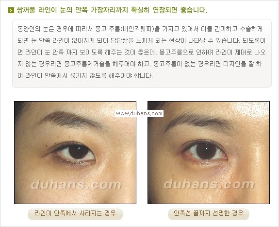 [두한성형외과 경쟁력 눈성형] - [눈성형, 쌍꺼풀 수술 방법에 관한 자주하는 질문과 답변 안내] 관련 이미지 2