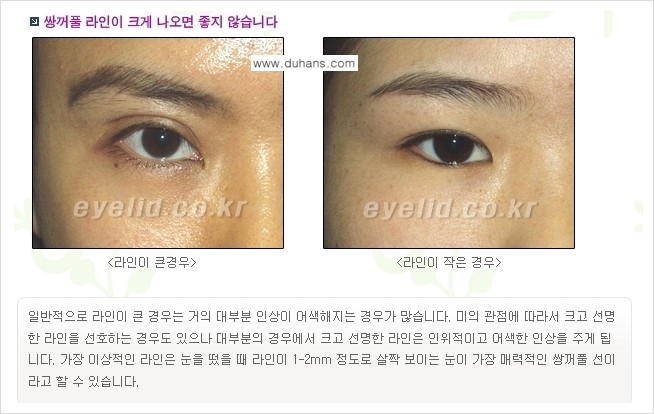 [두한성형외과 경쟁력 눈성형] - [퀵쌍꺼풀(부분절개법) 수술 안내] 관련 이미지 1