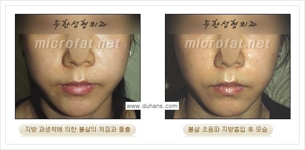 [두한성형외과 겨울엔 지방흡입을] - [볼살, 눈밑, 턱선의 초음파 미세지방흡입 2.] 관련 이미지 10