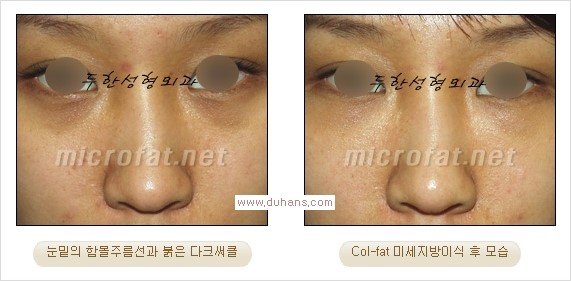 [두한성형외과 경쟁력 눈밑성형] - [눈밑 미세지방이식으로 다크써클 치료] 관련 이미지 16