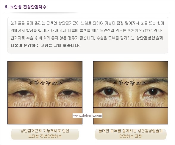 [두한성형외과 경쟁력 쌍꺼풀 재수술, 극한 눈재수술] - [안검하수 종류 안내] 관련 이미지 8